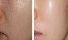 皮炎可以吃土瓜不,天然食材的神奇疗效